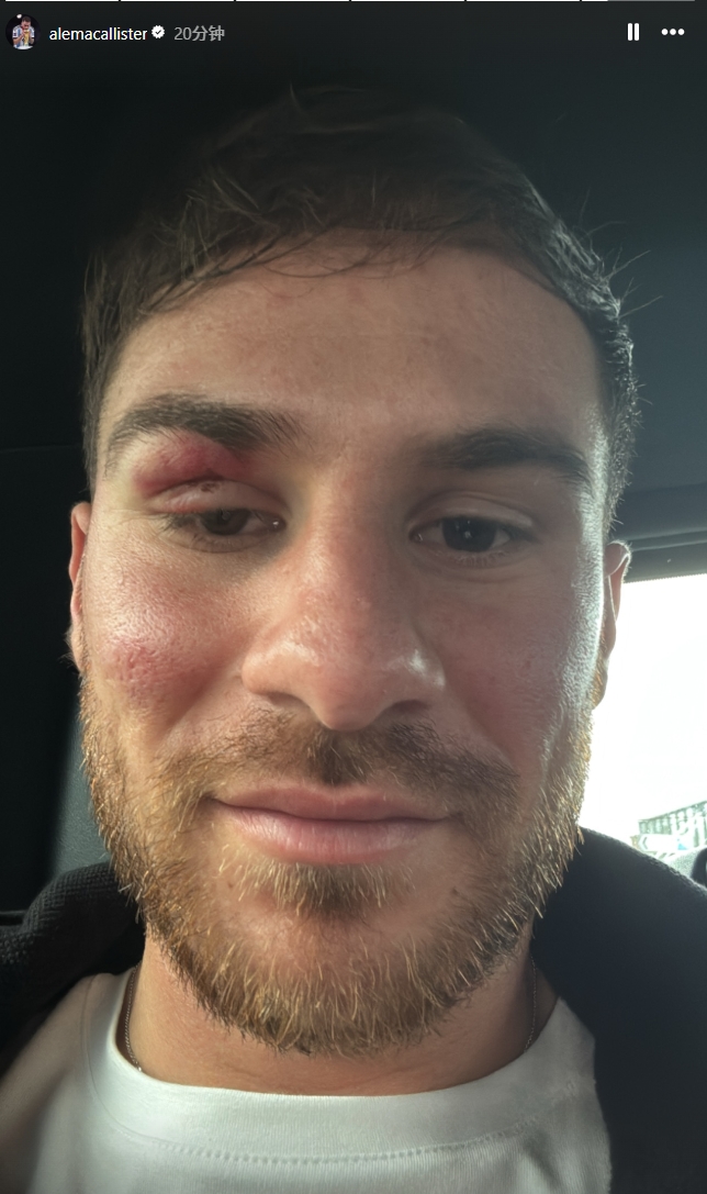 痛并快樂著！麥卡利斯特封堵馬爾穆什射門后“破相”，但心情不錯(cuò)