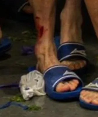 紅牌也不冤！被帕利尼亞蹬踏的波鴻球員，賽后小腿創(chuàng)口依然明顯